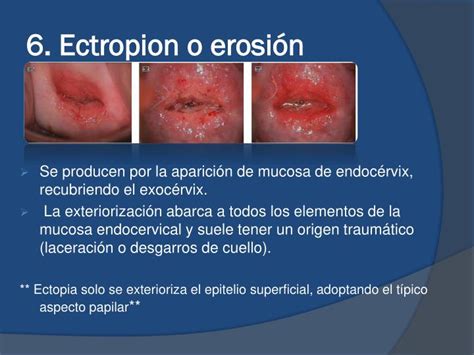 cervice uterina con ectropion
