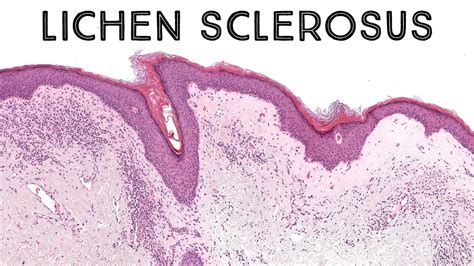 Immagine microscopica di una biopsia cutanea affetta da Lichen Sclerosus, mostrando le caratteristiche istopatologiche