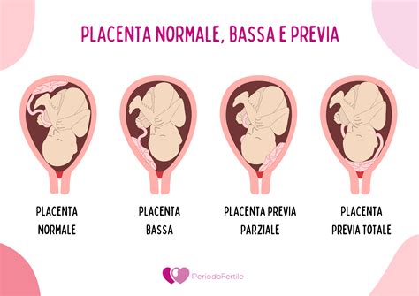 Diverse posizioni della placenta nell'utero (anteriore, posteriore, fundica, laterale)