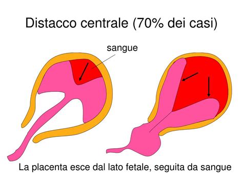 Distacco prematuro della placenta