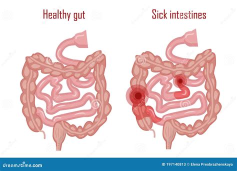 Diagram of healthy vs inflamed intestine