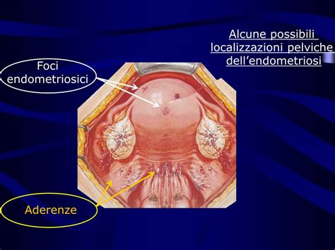 Diagramma che illustra l'endometriosi e le sue possibili localizzazioni pelviche