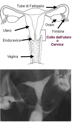 Illustrazione di isterosalpingografia con mezzo di contrasto nelle tube
