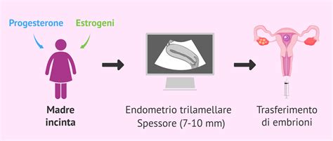 Trasferimento embrionale nell'utero