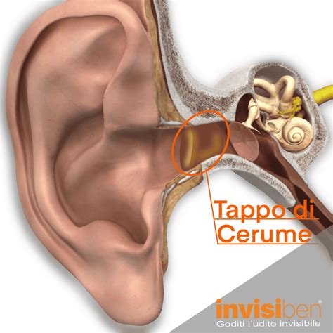 Tappo di cerume nel neonato