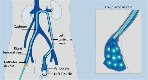 schema varicocele