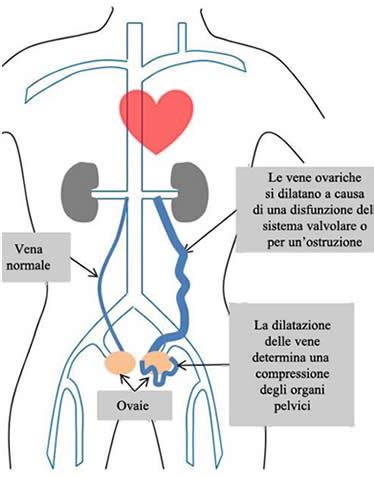 Sequenza di esami diagnostici per il varicocele pelvico