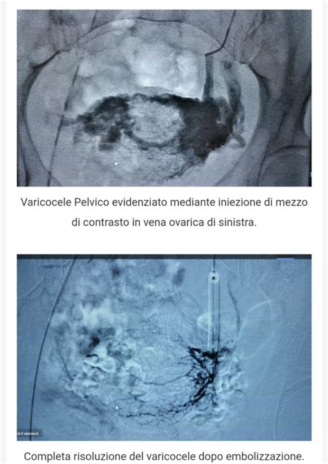 Illustrazione del processo di embolizzazione venosa pelvica