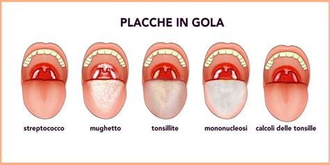 Bambino con mal di gola e placche