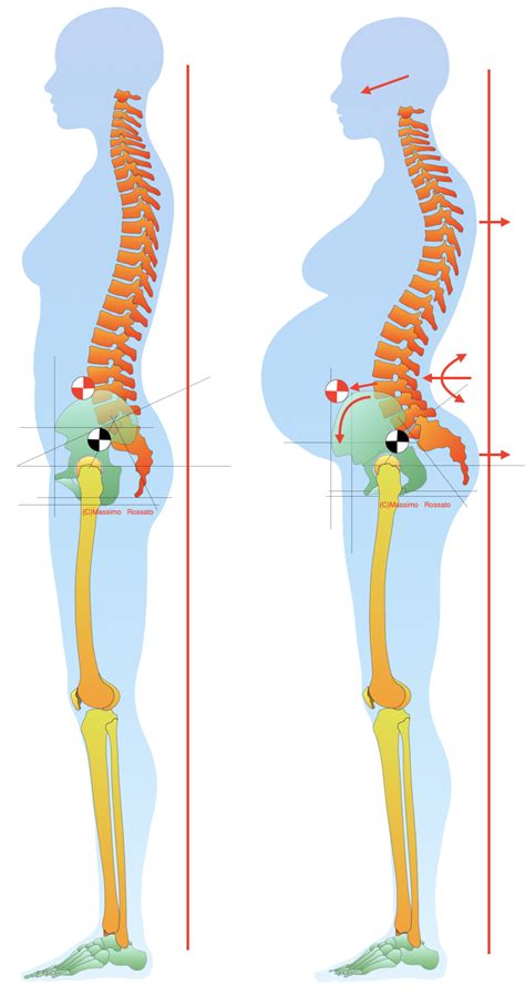 illustrazione dei cambiamenti posturali della donna durante la gravidanza