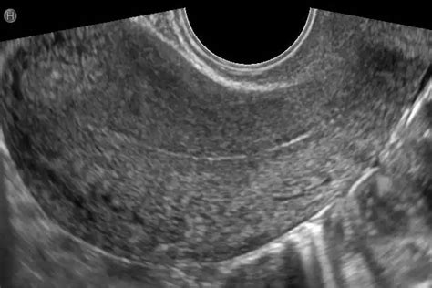 ecografia endometrio trilamellare