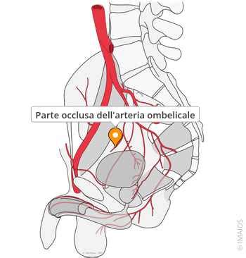 Diagramma di flusso del monitoraggio in caso di arteria ombelicale unica