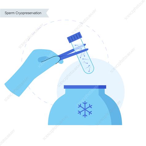 Sperm cryopreservation illustration