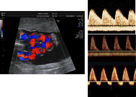 Immagine ecografica di flussimetria Doppler di un'arteria uterina