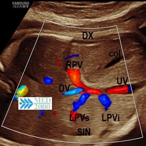 Immagine ecografica di Doppler del dotto venoso fetale