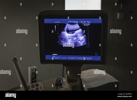 monitor ecografico con visualizzazione dell'embrione