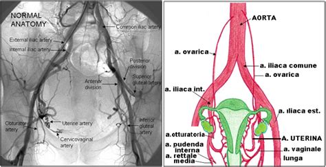 Embolizzazione dell'arteria uterina
