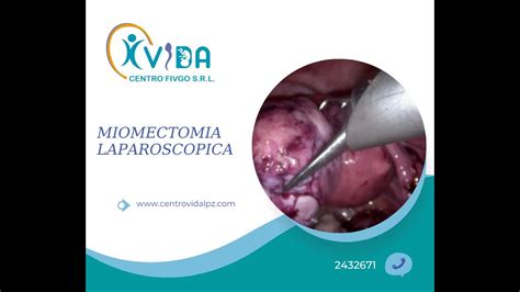 Miomectomia laparoscopica