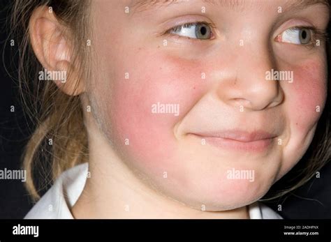 Guance rosse causate dalla quinta malattia