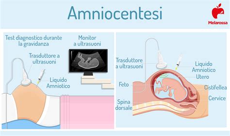 ecografia per amniocentesi