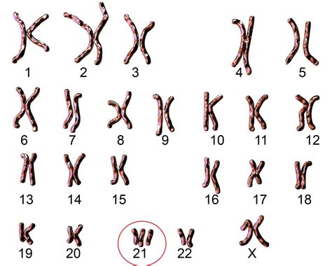 schema dei parametri ecografici utilizzati per lo screening della Trisomia 21