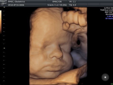 Ecografia 3D di un feto in utero