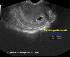Ecografia transvaginale che mostra un sacco gestazionale