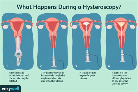 Hysteroscopy procedure diagram