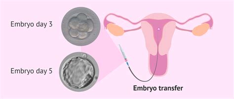 Transfer embrionario