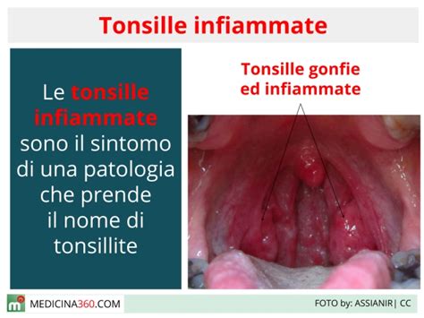illustrazione anatomica della gola e delle tonsille infiammate