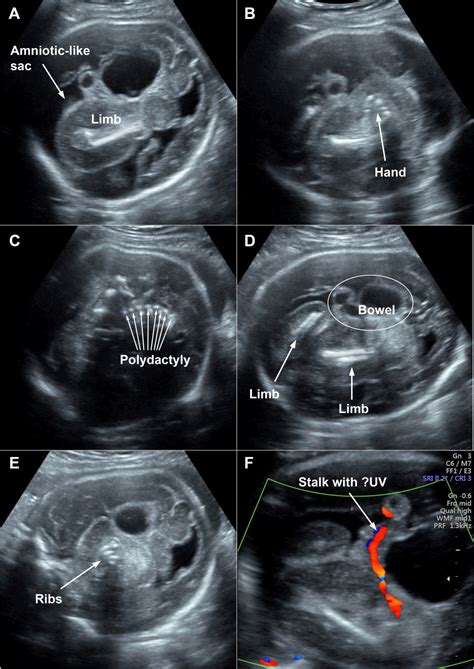Rappresentazione di Fetus in Fetu