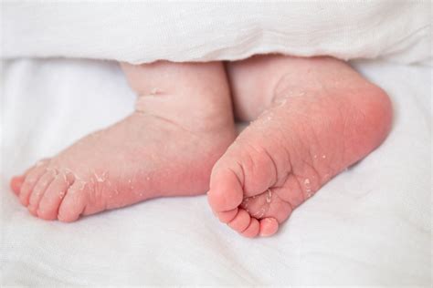 Pelle di neonato screpolata