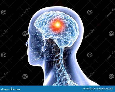 Illustrazione di un cervello con un tumore benigno