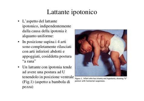 Lattante con pertosse severa