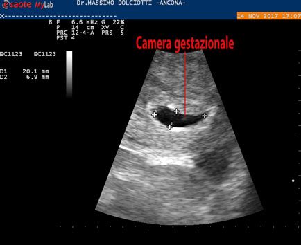 rappresentazione ecografica di una camera gestazionale iniziale
