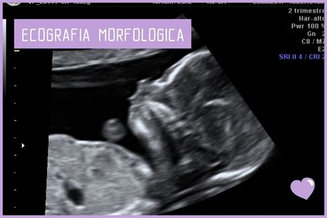 Ecografia morfologica