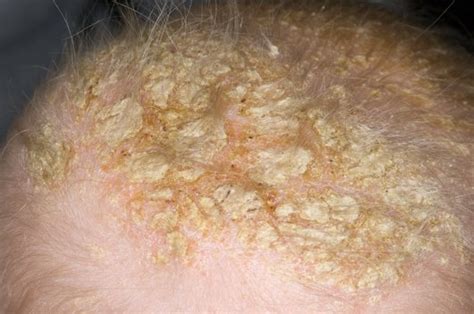 Dermatite seborroica vs crosta lattea