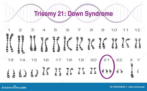 rappresentazione schematica del cariotipo umano con trisomia 21