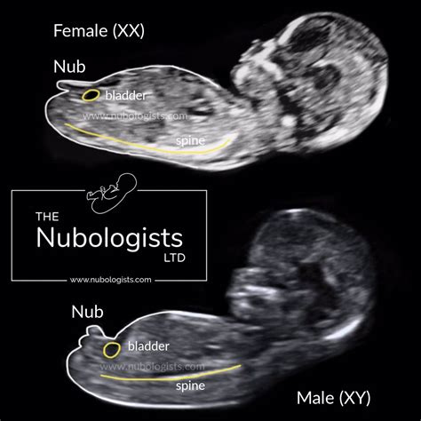 diagramma che illustra la Nub Theory, mostrando le differenze angolari tra feto maschio e femmina durante un'ecografia