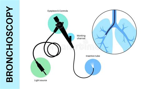 rappresentazione schematica del sistema respiratorio e posizionamento del broncoscopio per il lavaggio broncoalveolare