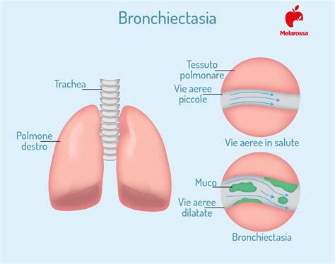 infografica comparativa tra gruppo BAL e gruppo standard: tassi di bronchiectasie e infezioni