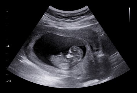 Early pregnancy ultrasound