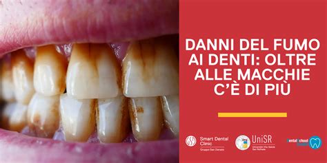 Danni ai denti e alla mascella causati dall'uso prolungato del ciuccio