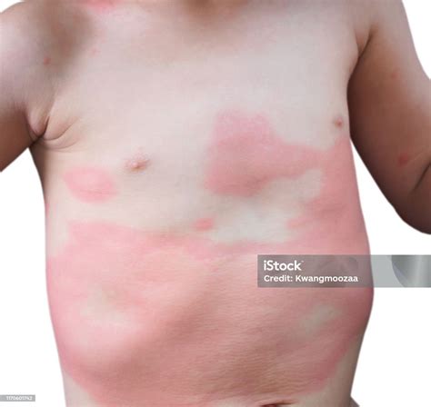 Eruzione cutanea tipica da reazione allergica