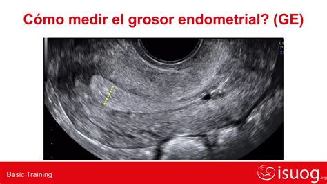 Ecografia dell'utero con endometrio preparato