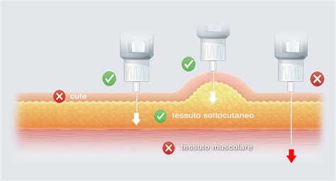 Tecnica di iniezione sottocutanea