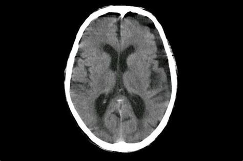 igroma cerebrale immagine diagnostica