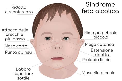 Dismorfia facciale nella sindrome alcolica fetale