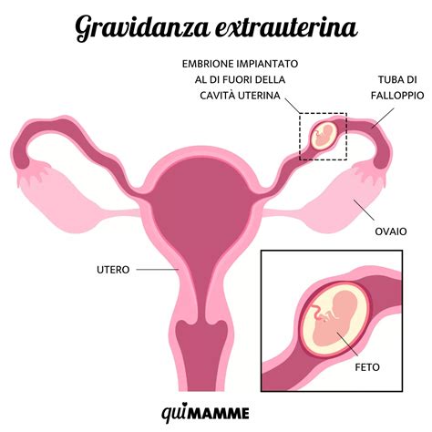 schema gravidanza extrauterina