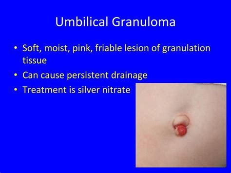 Granuloma ombelicale aspetto